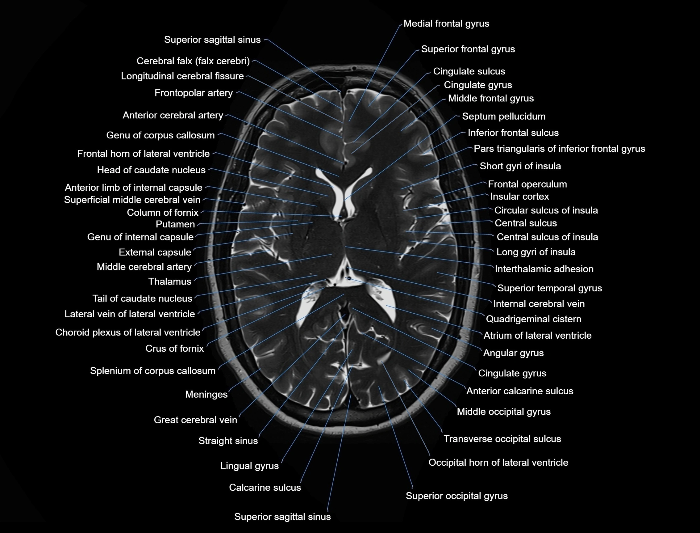 MRI Brain axial cross sectional radiology anatomy 3T image  -img-00001-00031.webp